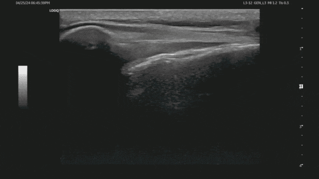 초음파 gif